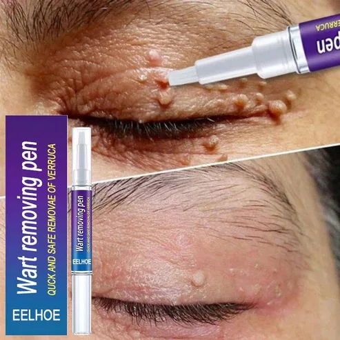 Wart Remover